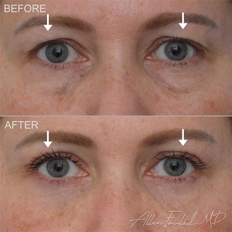 Best Eye Cream After Blepharoplasty at David Sells blog