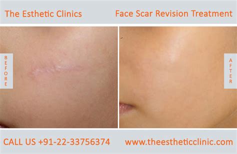Scars Removal Surgery Cost | Renew Physical Therapy