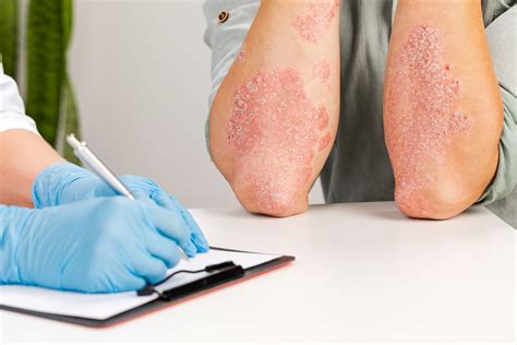 Psoriasis Flare-Ups: How to Prevent and Treat Them - Aesthetic Dermatology
