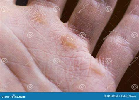 Callus In The Hand