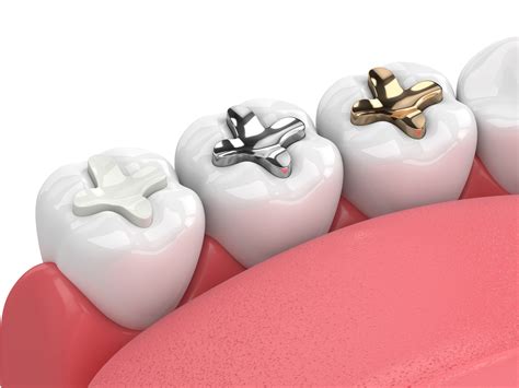 Willis Family Dental | Inlays and Onlays