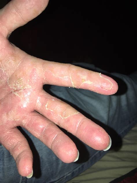 Dyshidrotic eczema + Shellfish allergy. Hands so swollen can’t close ...