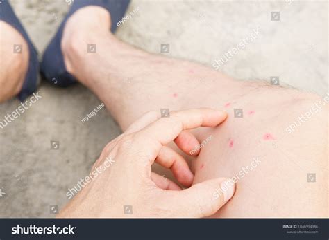 82 imágenes de Sandfly bites - Imágenes, fotos y vectores de stock ...