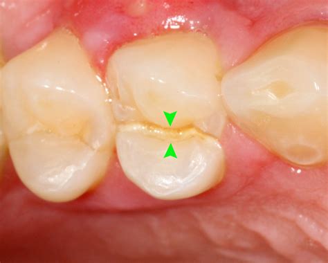Crack Lines In Teeth at Toni Esser blog