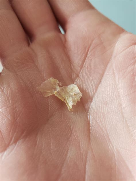 I have a life long problem with my left ear. No wax, just skin. Read ...