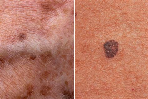 Melanoma Spots On Chest