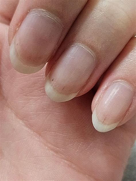 Horizontal Lines On Nails Ridges In Fingernails: Symptoms, Causes, And