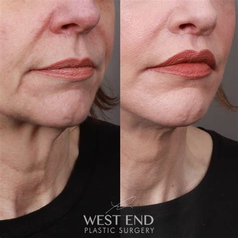 Corner Lip Lift Procedure at Samantha Tennant blog