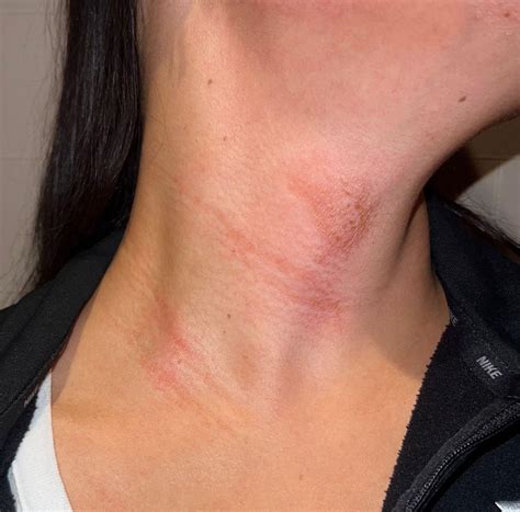 Rash on neck : r/yachting