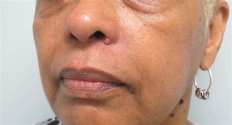 Basal Cell Cancer Melanoma at Marianne Coleman blog