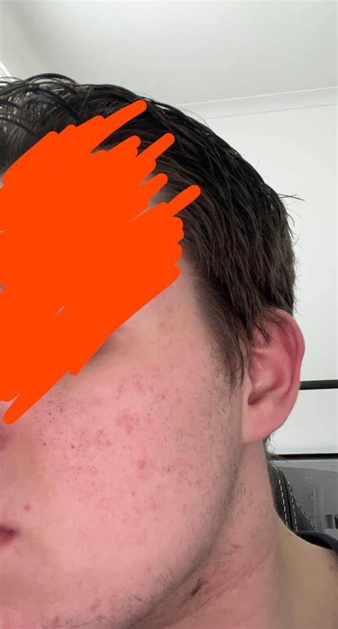 Possible fungal acne- cheeks + forehead. : r/Fungalacne