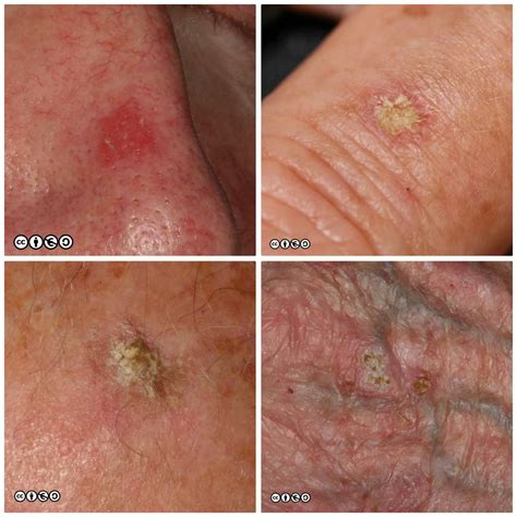 Pre Skin Cancer Keratosis