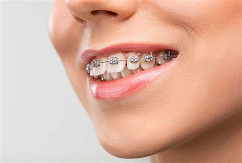 How Do Braces Work to Straighten Your Teeth? Nearest Dental Clinic