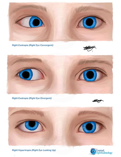 Strabismus (Squint), Sunshine Coast Squint Surgery