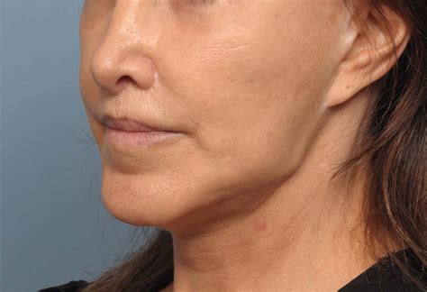 female face reshaping oblique 1 - Explore Plastic Surgery