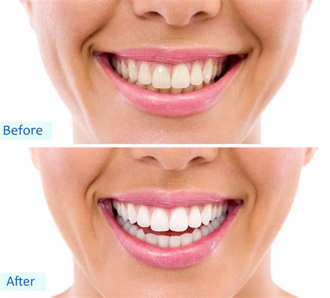 Edmonton Teeth Whitening - Illuminada Dental - Enjoy a Healthy Smile!