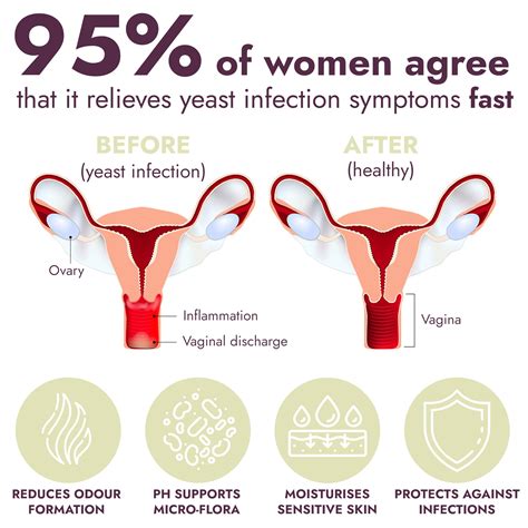 Vaginal Infections in Women: Symptoms, Causes, and Treatments - Reproductive Health - sex with yeast
