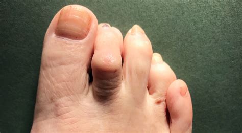 Lesser Toe Surgery | Hammer Toe Straightening | David Redfern