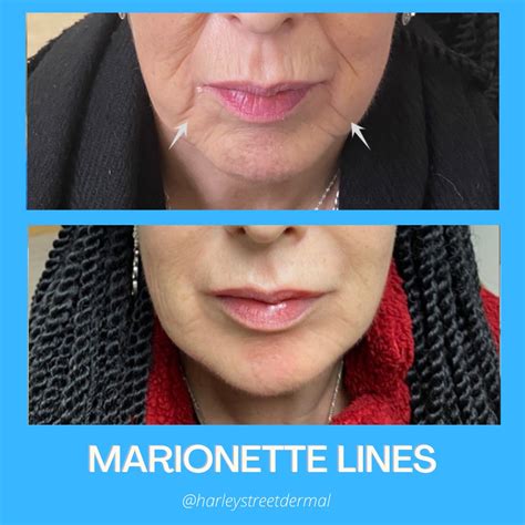 Before & After | Harley Street Dermal