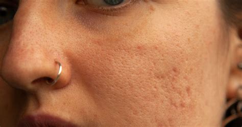 How To Get Rid Of Hormonal Acne — Causes, Treatment