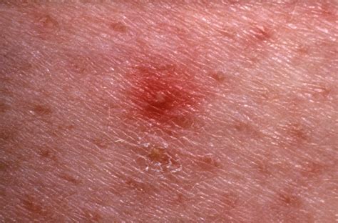 Red Dots On Skin Red Spots On Skin: 16 Common Causes