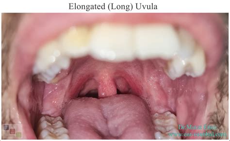 Elongated (Long) Uvula Causes, Symptoms and Treatment