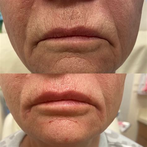 Upper Lip Botox Before And After at Levi Irvine blog