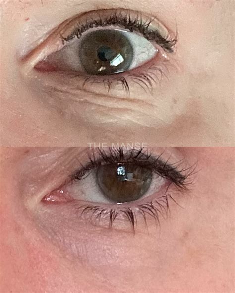 For Under Eye Wrinkles Laser