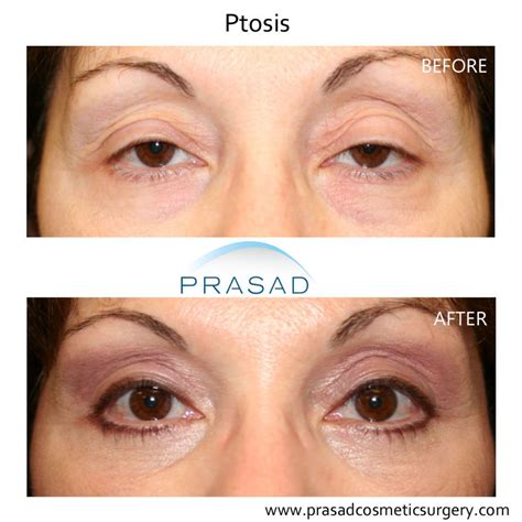Droopy Eyelid Surgery: Eyelid Ptosis Procedure, and Recovery
