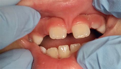 Signs Your Child May Have a Lip or Tongue Tie—and How We Treat It - Children's Dentist Near Me ...