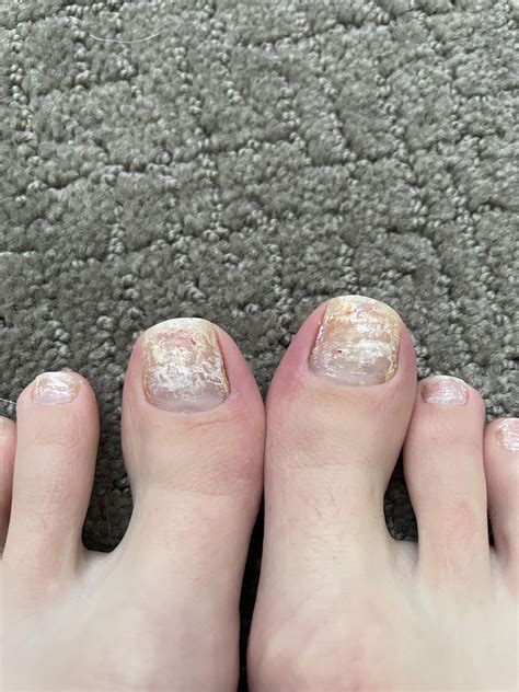 Toe Nail Fungus? Wondering if anyone has any insights on what this is ...