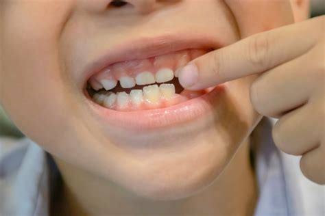 Pain From Braces: Ways on How To Lessen It - MOM News Daily
