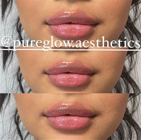 Lip Injections | Botox lips, Lip injections, Lip fillers