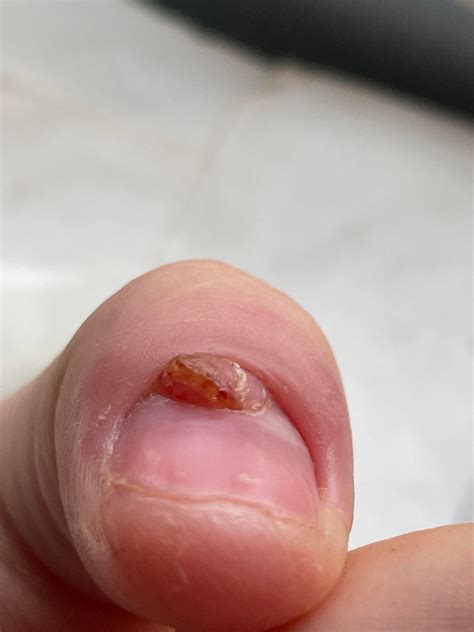 Hole in my nail has flesh coming out pls help lol : r/calmhands