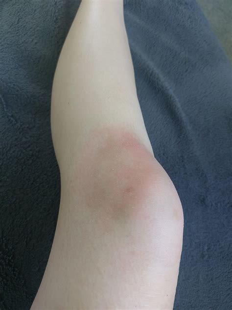 Knee sprain got worse? : r/medical
