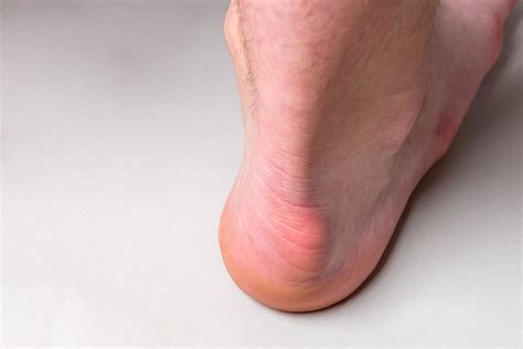 Bump on the back of heel bone called Haglund’s deformity on gray background. • Frisco Foot ...