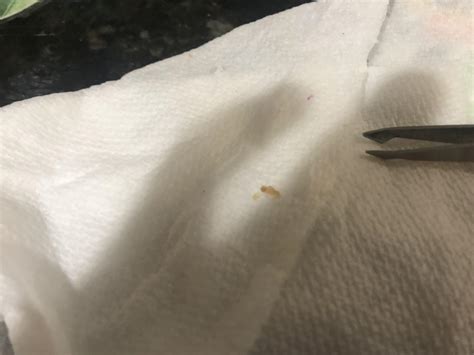 Massive Blackhead Popping