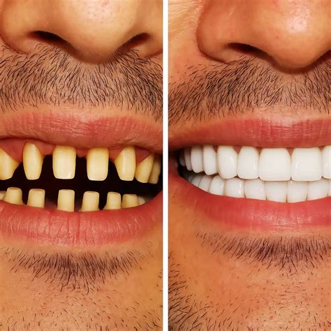 أسنان مشذبة للفينير: المخاطر، الفوائد، والإجراء | Lema Dental Clinic