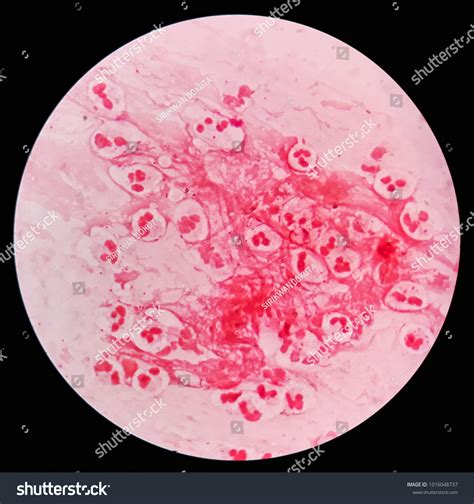 Gram Negative Diplococci In Sputum