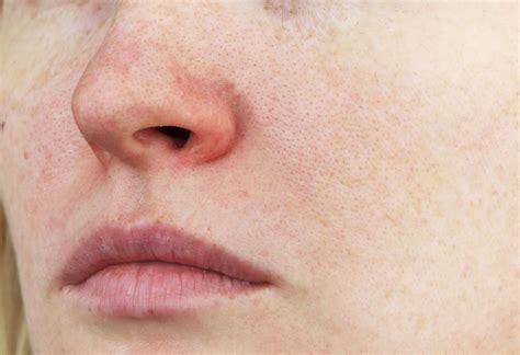 Mild Rosacea Cheeks