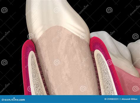 Morphology Of Maxillary Lateral Incisor Tooth And Gum. Medically ...