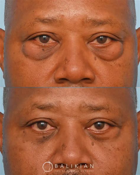 Facial Fat Transfer Before & After Gallery : Real Transformations