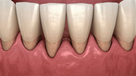 What Causes Receding Gums? - Affinity Dental