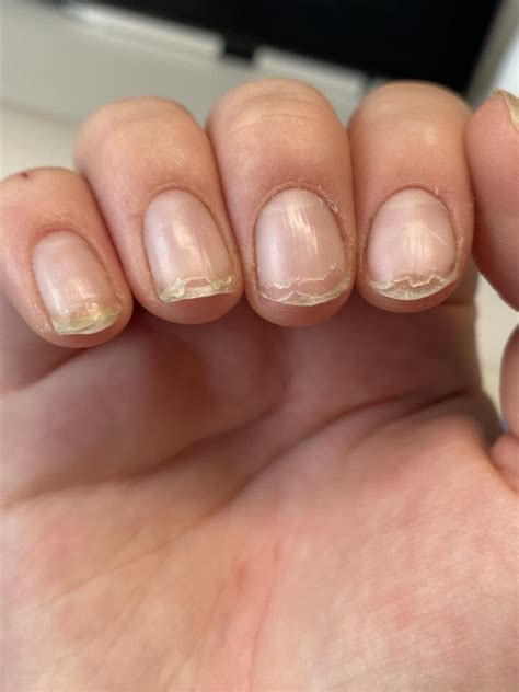 Why are my nails peeling? : r/lacqueristas