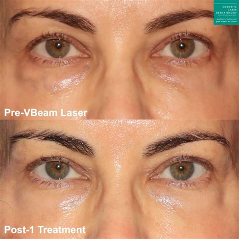Facial Vein Removal Medi Spa | San Diego, CA | CLDerm