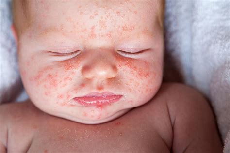Infant Neck Rash
