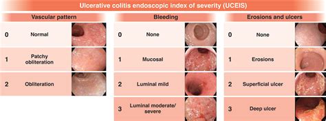 Stages Of Ulcerative Colitis