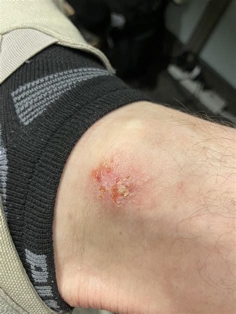 Itchy lesion on ankle. : r/DermatologyQuestions