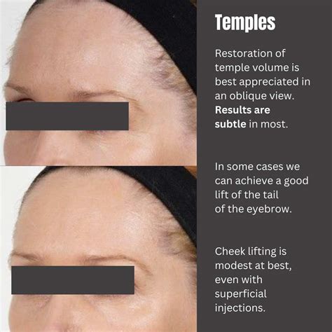 Temple Fillers - Dr Davin Lim