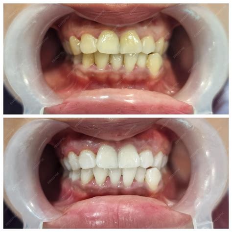 Before and after scaling and polishing treatment for yellow stains on the teeth | Premium AI ...